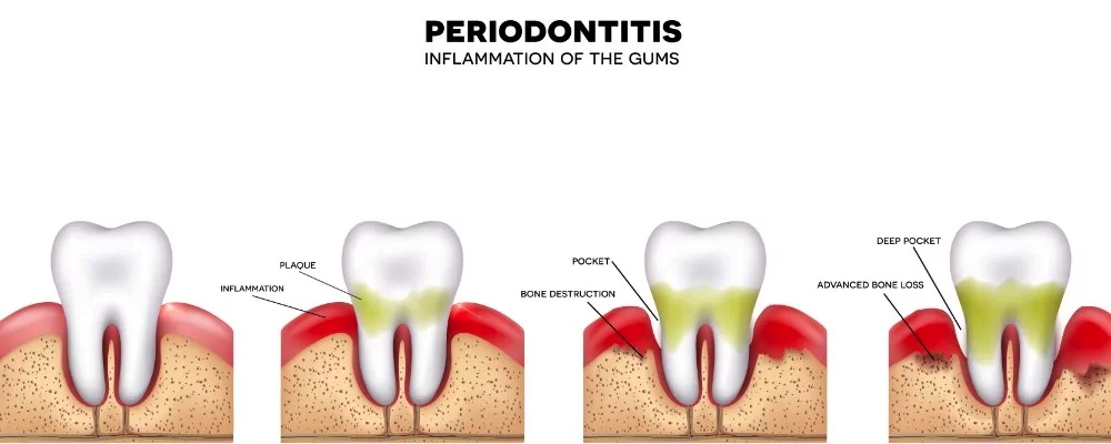 Gum Inflammation