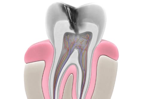 Root Canal